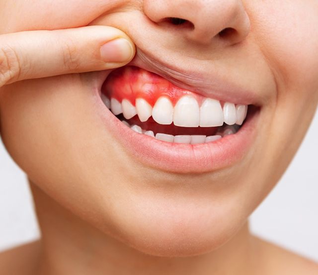 A woman showing inflamed gums against a gray background